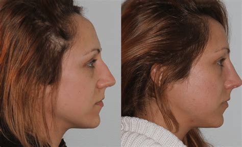 Homeopathy for nasal allergies is very effective. Broken Nose Before and After - New York, NY Sinus Surgeon