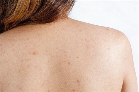 Easy And Effective Home Remedies To Treat Back Acne Scars