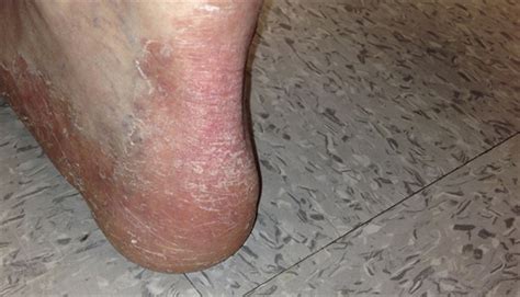Derm Dx Scaly Rash On The Feet Clinical Advisor