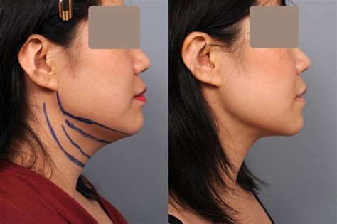 Neck Liposuction Chin Liposuction Before And After Photo Gallery My