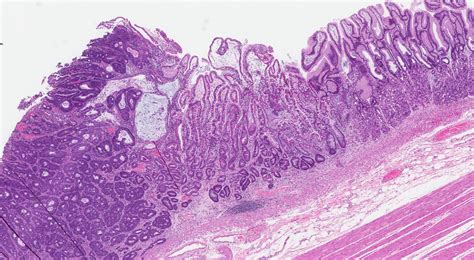 Gastric Adenocarcinoma Histology