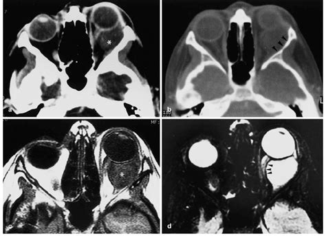 Ad Epidermoid Cyst Of The Orbit A A Contrast Enhanced Axial Ct Scan