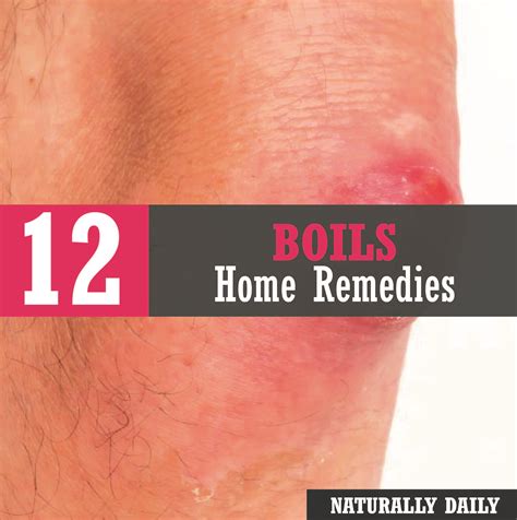 How To Get Rid Of Boils Fast 17 Home Remedies That Work Get Rid Of