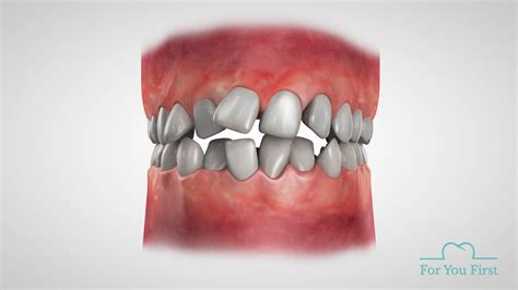3d Animation Showing Teeth Movements Youtube