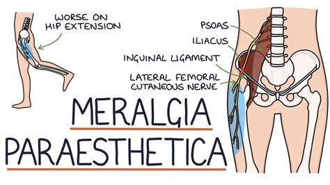 How To Sleep With Meralgia Paresthetica Archives Healing Picks