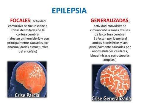 Convulsiones Y Epilepsia