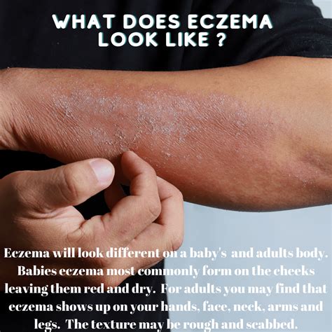 What Does Eczema Look Like Butta Babee Hair And Skin Care