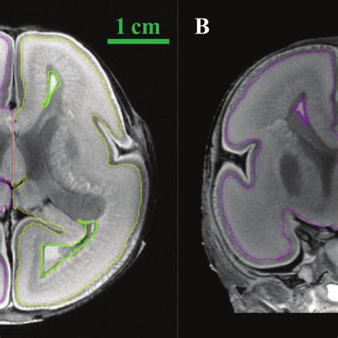 The Morphologic Evolution Of Fetal Lateral Ventricles At 14 31 Weeks