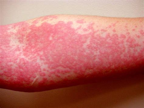 Extremely Rare Disorder Aquagenic Urticaria Allergic To Water Rmedizzy