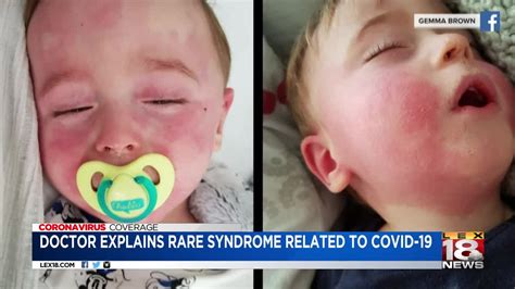 What to know if you get a rash during the pandemic and whether it could be related to coronavirus. Kentucky ICU nurse called back to New York City