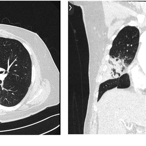 Chest Computed Tomography Demonstrating Consolidation Within The