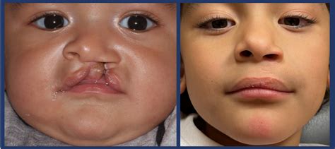 Cleft Lip Surgery Before And After
