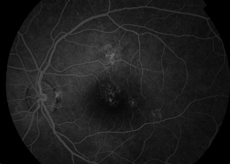 Central Serous Retinopathy Csr Retina Image Bank