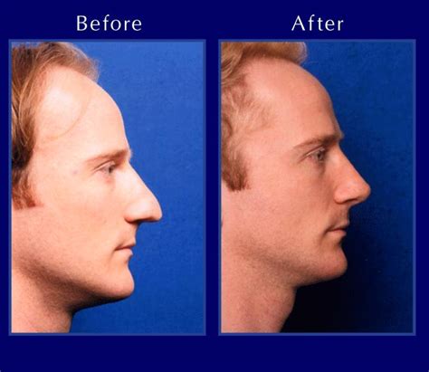 The Nose Clinic Before And After Nose Surgery Photos 6