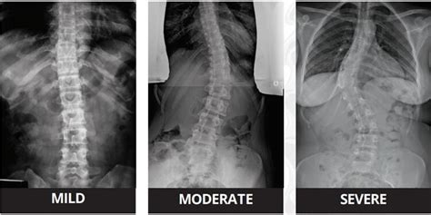 Mild Moderate And Severe Scoliosis The Three Stages Of Scoliosis