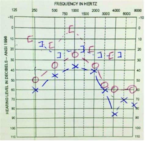 How To Read An Audiogram For Hearing Loss How To Read An Audiogram