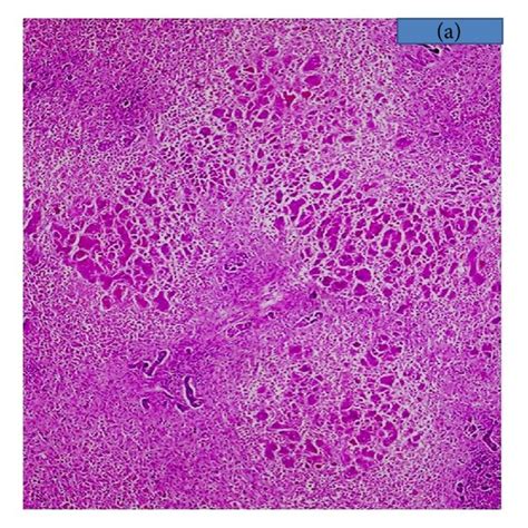 Pdf Postinfantile Giant Cell Hepatitis An Etiological And Prognostic