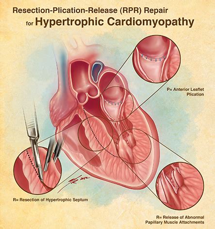 Pin by nonas arc on Hypertrophic Cardiomyopathy (HCM) | Human body