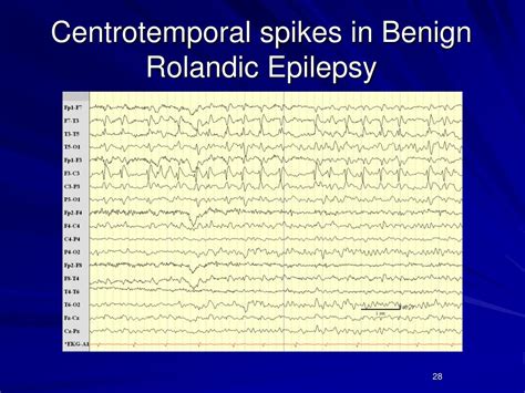 Ppt Pediatric Epilepsy An Overview And Update On