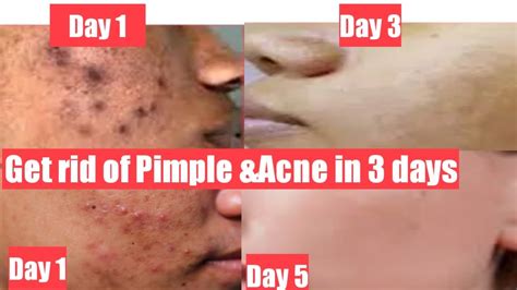 How To Get Rid Of Pimple Acne And Black Spots In 3 Days Fastest Way