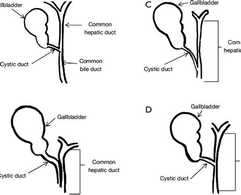 Cystic Duct Variant Anatomy