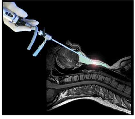 Image Of An Endoscopic Minimally Invasive Transoral Approach For
