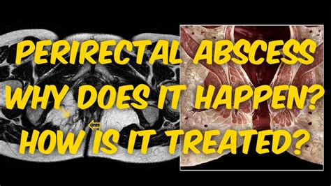 Perirectal Abscess Youtube