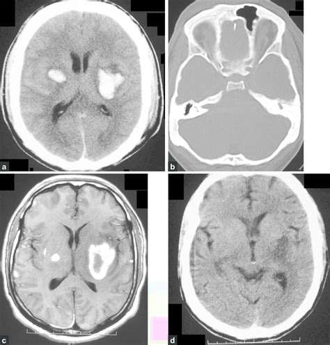 A Patient 1 Initial Plain Ct Showing Bilateral Basal Ganglia Bleed