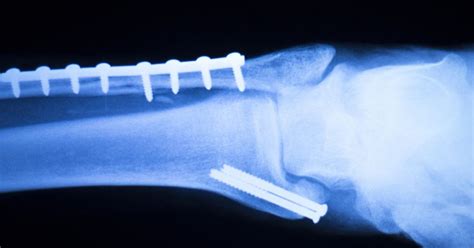 Metal Surgical Screws And Pins May Be A Thing Of The Past