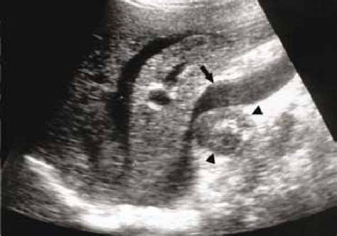 Abdominal Ultrasound That Shows The Well Defined Hypoechoic Mass