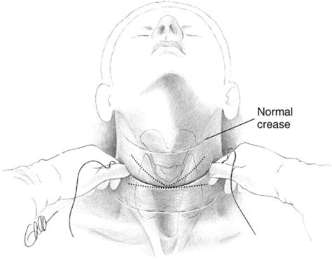 Conventional Thyroidectomy In The Treatment Of Primary Thyroid Cancer