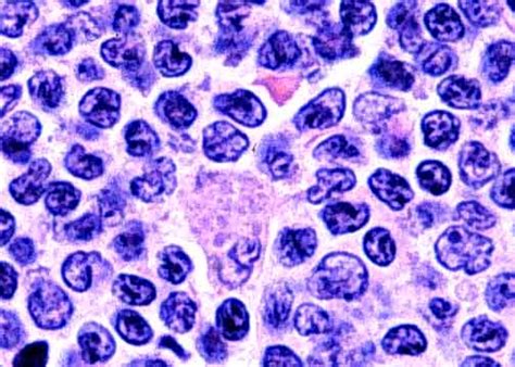 Mantle Cell Lymphoma Images