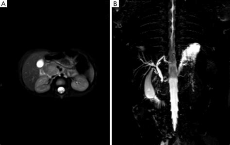 Mrcp Scan Showing The Lesion In The Uncinate Process Of The Pancreas