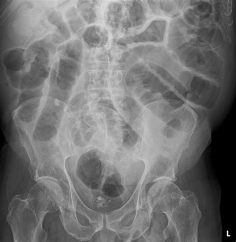 Small Bowel Obstruction Image