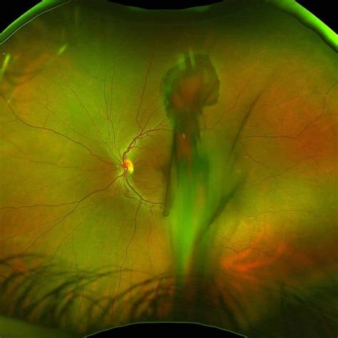 Retinal Aterial Macroaneurysm Outlook Eye Specialists