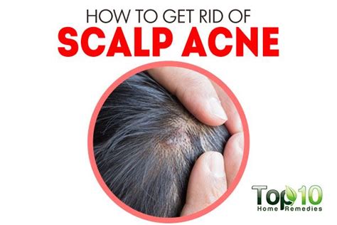 How To Get Rid Of Scalp Acne Top 10 Home Remedies Scalp Acne Scalp