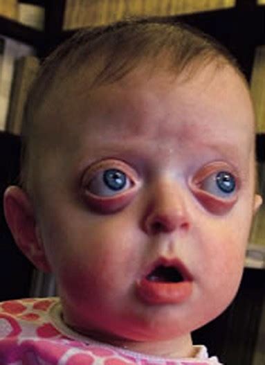 Sep 10, 2019 · symptoms include bulging eyes, bone pain, dark eye circles, a lump in the neck, chest, or abdomen, weakness, or swollen stomach. Pfeiffer syndrome - Pictures, Types, Symptoms, Causes ...