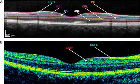 Layers Of Retina On Oct