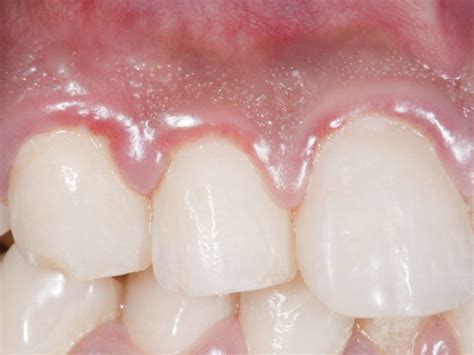 Oblečení Káva Vlastník White Spots On Gums Plachta Potřebuji Velký