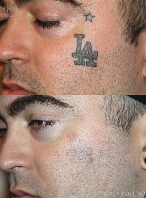 Whether you've just gotten your tattoo or have had it for longer than you'd like, using salt to remove a tattoo is a dangerous proposition. Efficient removal of unwanted tattoos using advanced lasers