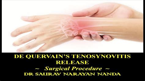 De Quervain S Tenosynovitis Release Surgical Procedure Dr Saurav N Nanda Youtube