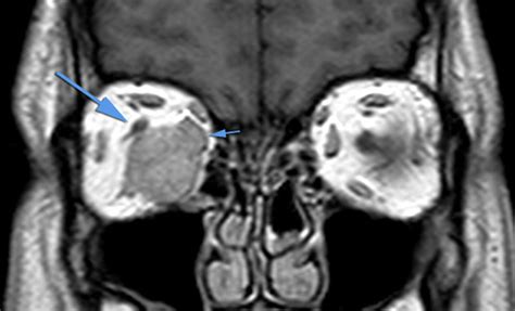 Patient 5 Orbital Venous Malformation Type 1 Ovm1 Preoperative