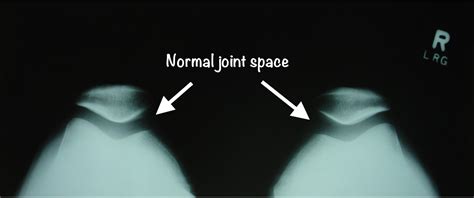 Normal X Ray Knee Sunrise View The Curbsiders