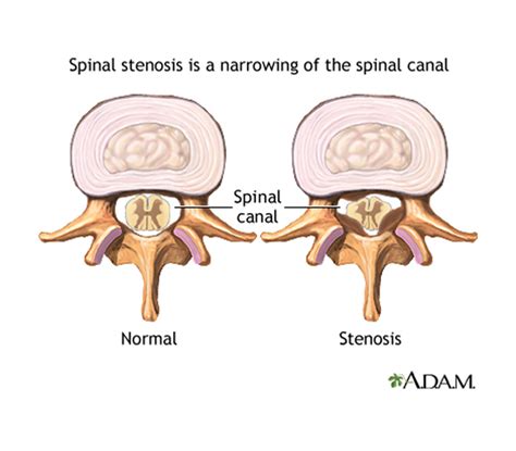 Spinal Stenosis Symptoms And Treatment Live Science