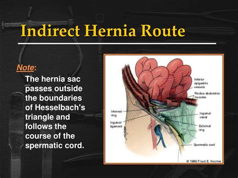 Ppt Inguinal Hernias Powerpoint Presentation Id218475