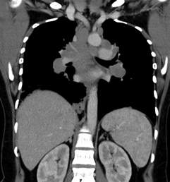 Tuberculous Mediastinal Lymphadenopathy In An Adult Bmj Case Reports