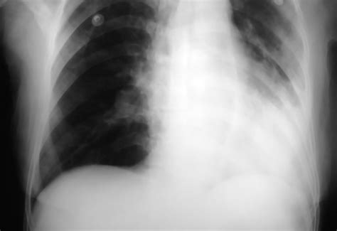 The actual diagnosis of pneumonia is not correlated with imaging in this study. New CHEST Guideline for Acute Cough Due to Suspected ...