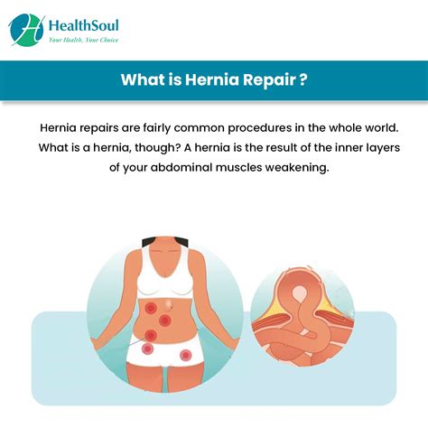 Hernia Repair Indications And Complications Healthsoul