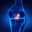 Knee Ligament & Joint ReplacementAnterior Cruciate Reconstruction