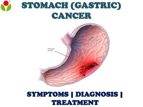 You may also have trouble swallowing or might have indigestion after you eat. STOMACH CANCER: See why you should not joke with ULCER.